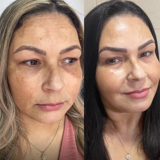 Antes e depois frontal: manchas de melasma nas maçãs do rosto e testa, depois pele mais uniforme.