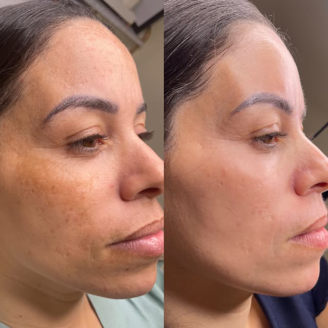Depois: lateral do rosto com a pele mais uniforme e as manchas de melasma clareadas.