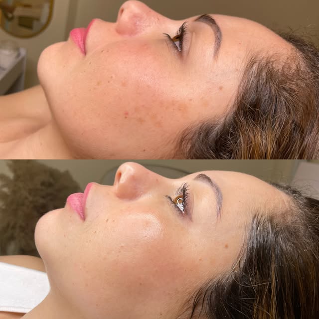 Antes e depois em perfil: manchas nas bochechas e depois pele luminosa.